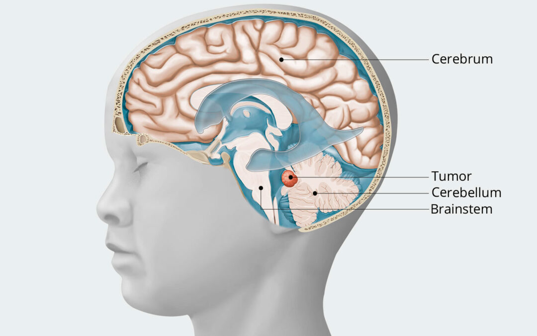 Medulloblastoma, WNT-activated